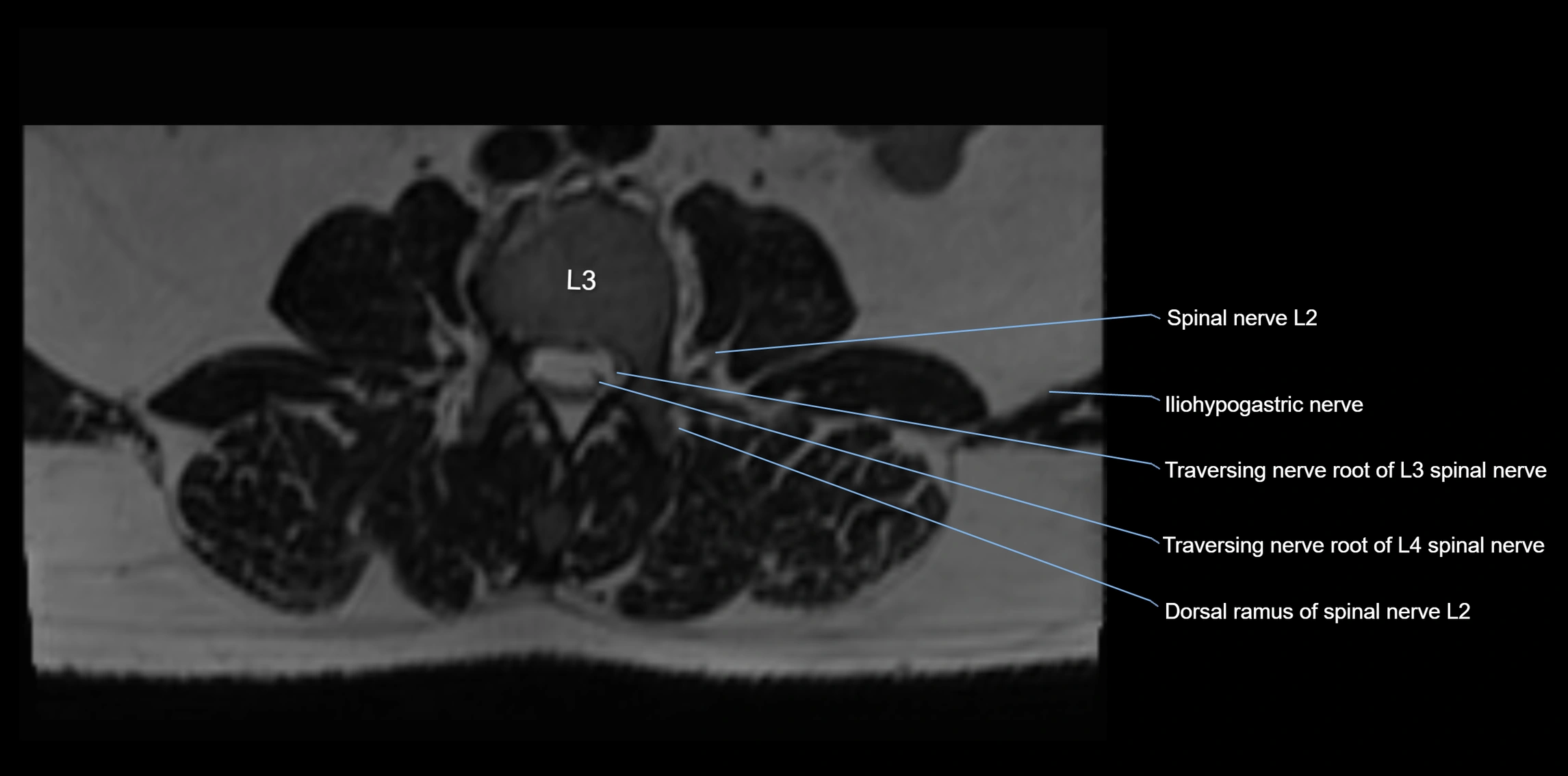 MR lumbosacral plexus axial cross sectional anatomy 3T  radiology  image-img-1008001-00017.webp